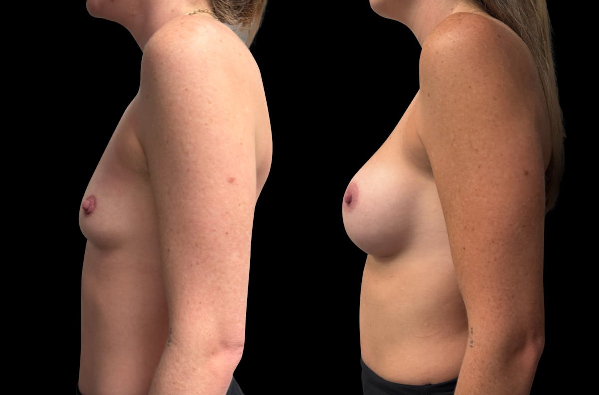 Breast Augmentation Before & After Gallery - Patient 150963 - Image 3
