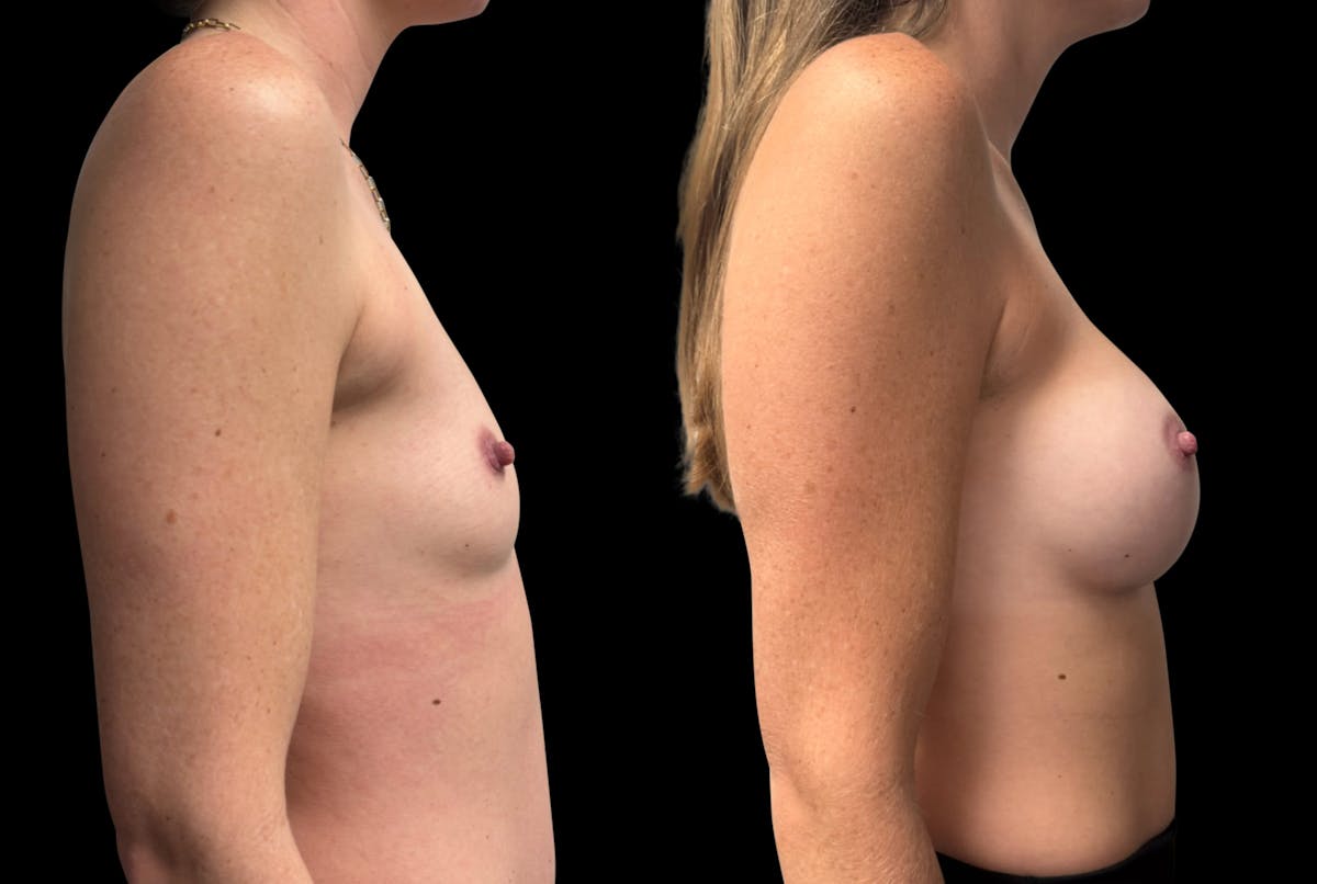 Breast Augmentation Before & After Gallery - Patient 150963 - Image 5