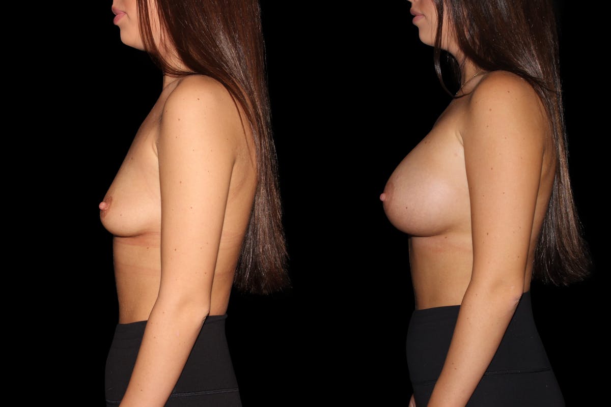 Breast Augmentation Before & After Gallery - Patient 443317 - Image 3