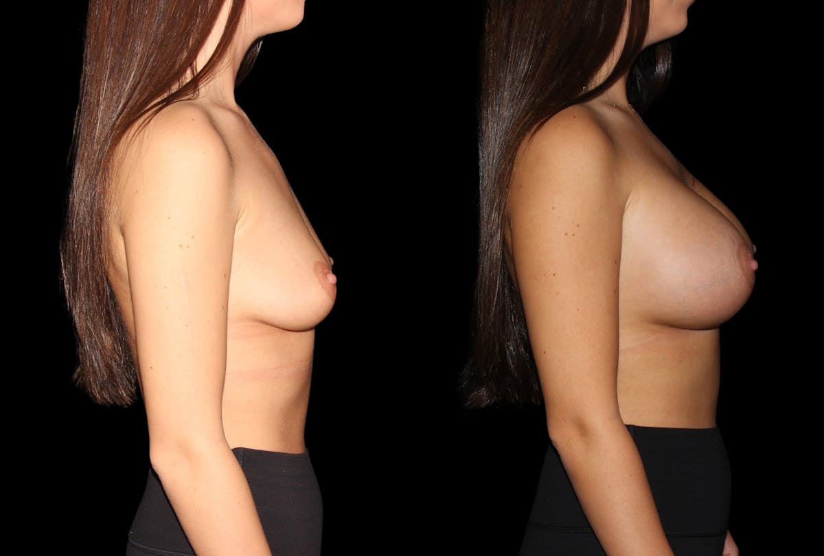 Breast Augmentation Before & After Gallery - Patient 443317 - Image 5