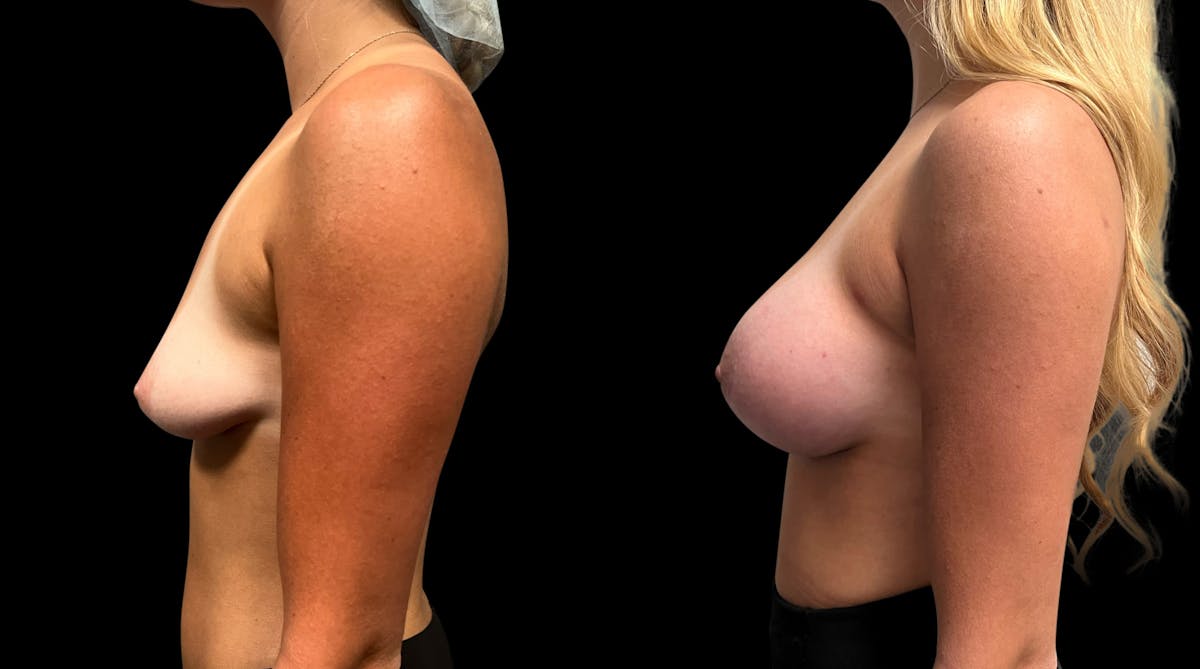 Breast Augmentation Before & After Gallery - Patient 152807 - Image 3