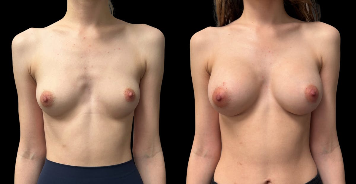 Breast Augmentation Before & After Gallery - Patient 956729 - Image 1