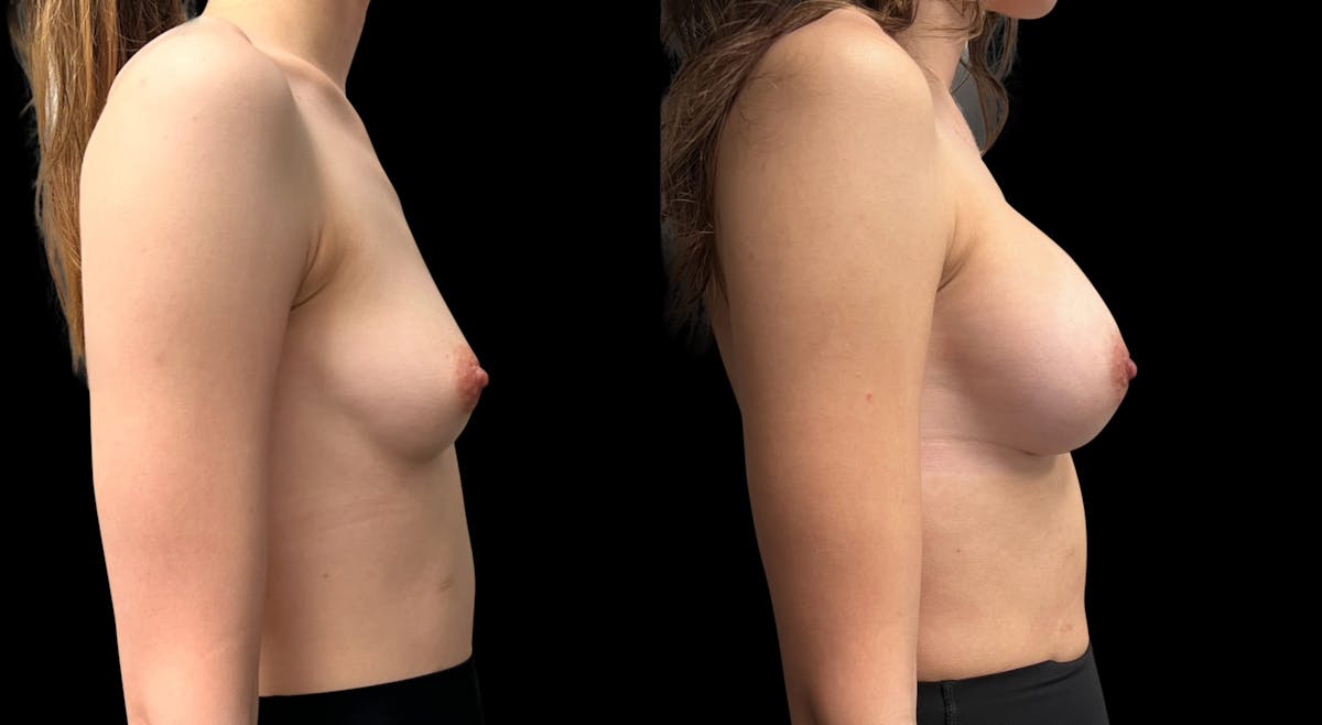 Breast Augmentation Before & After Gallery - Patient 956729 - Image 3