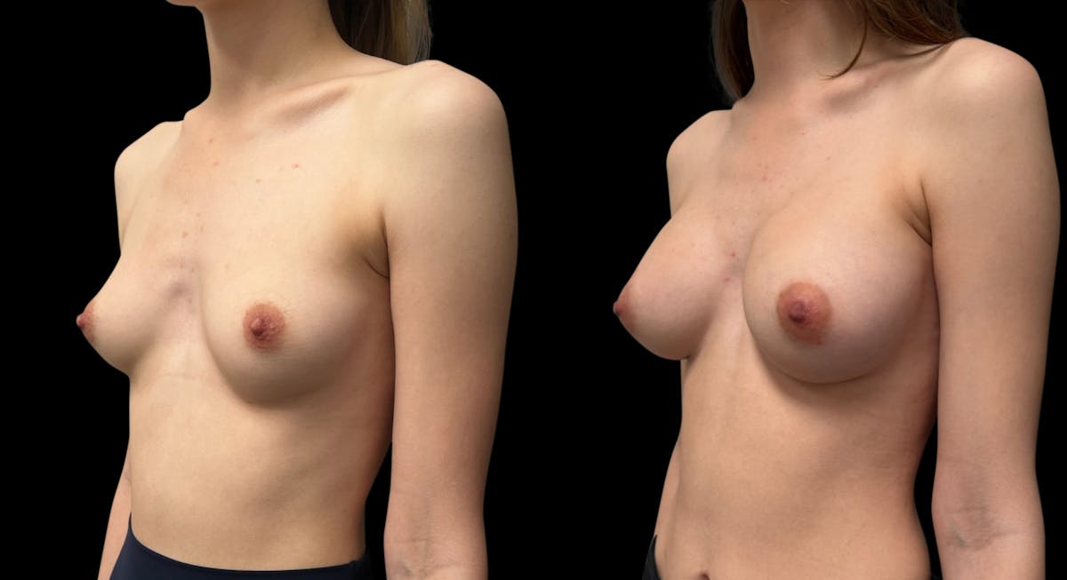 Breast Augmentation Before & After Gallery - Patient 956729 - Image 4