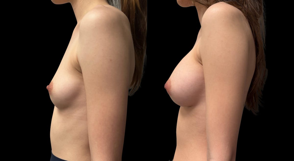 Breast Augmentation Before & After Gallery - Patient 956729 - Image 5
