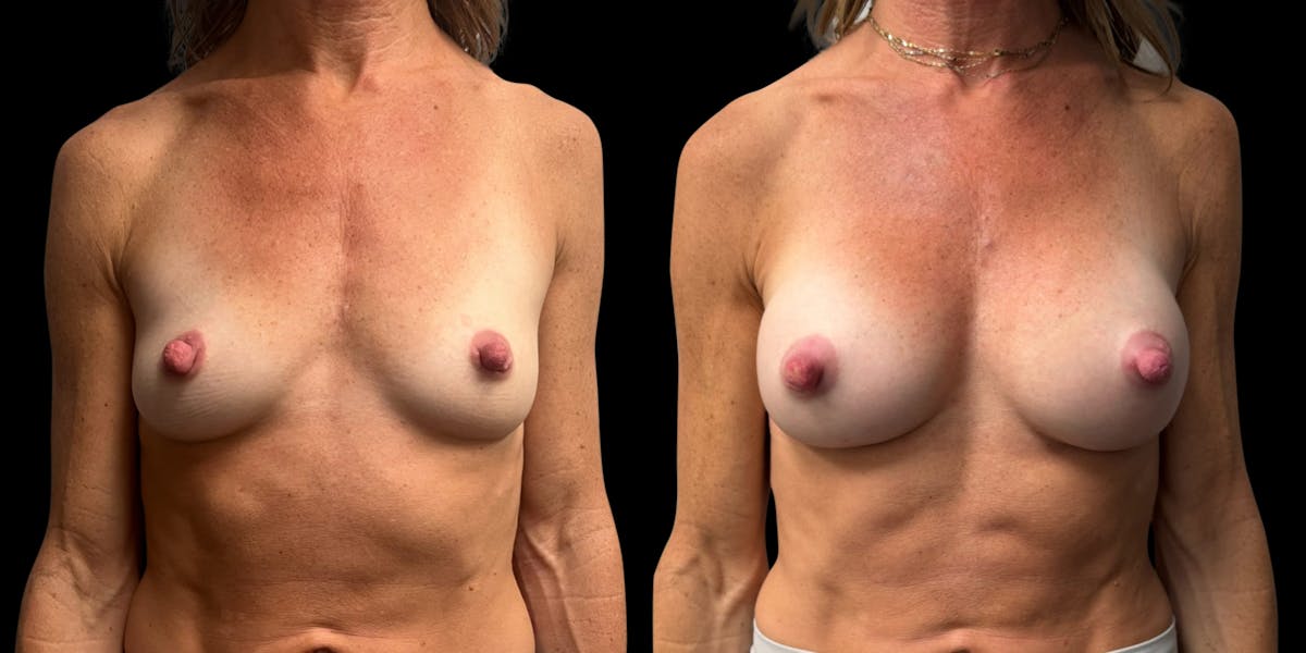 Breast Augmentation Before & After Gallery - Patient 165113 - Image 1