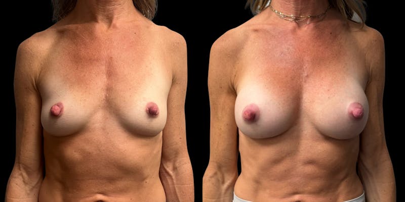 Breast Augmentation Before & After Gallery - Patient 165113 - Image 1