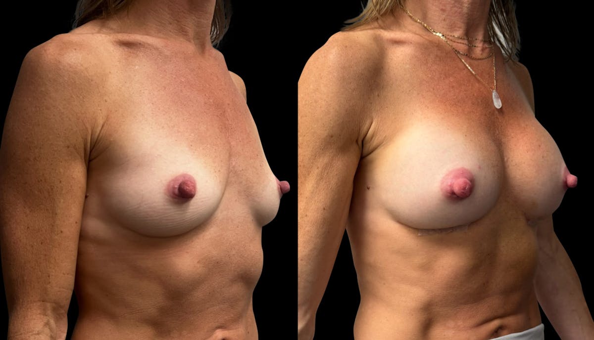 Breast Augmentation Before & After Gallery - Patient 165113 - Image 2