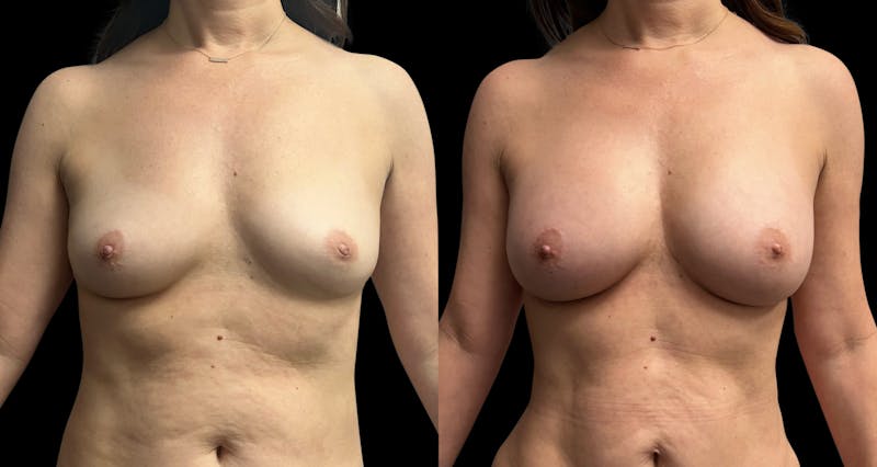 Breast Augmentation Before & After Gallery - Patient 102781 - Image 1