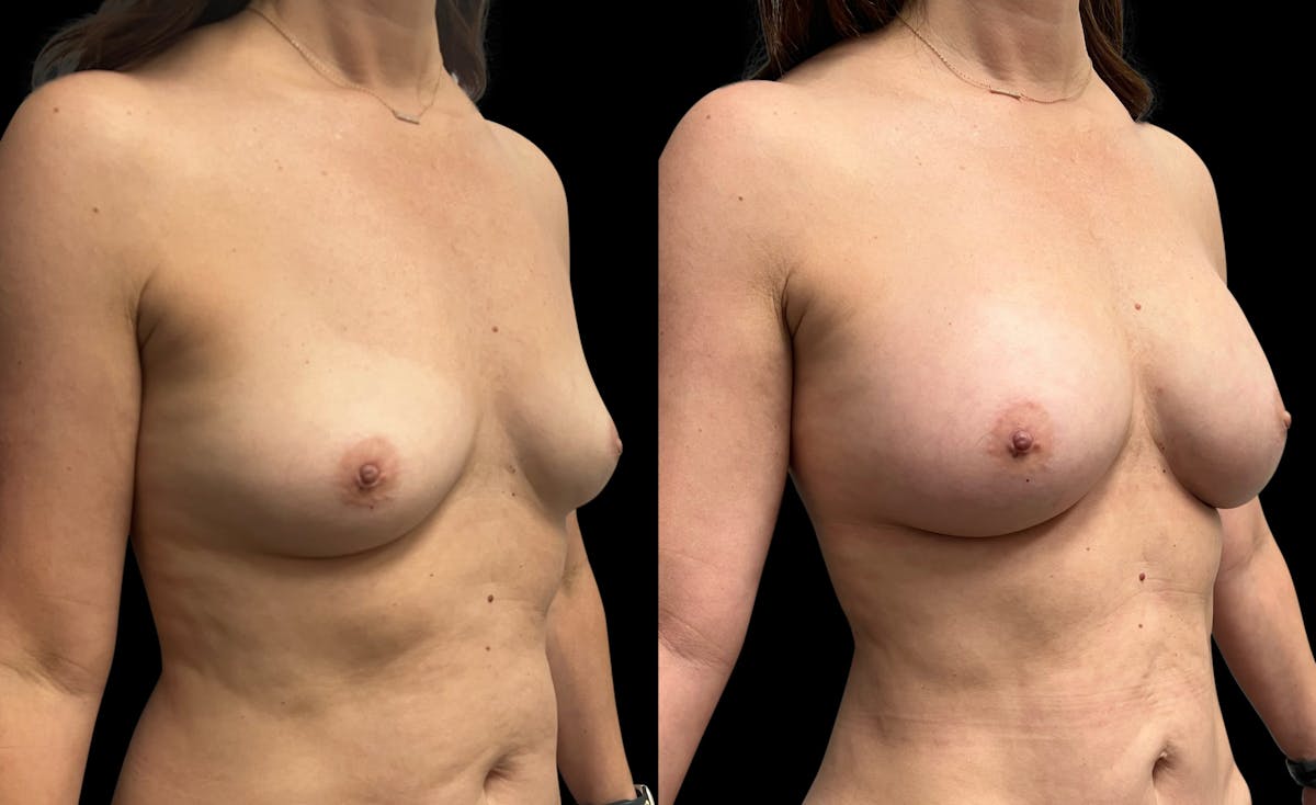 Breast Augmentation Before & After Gallery - Patient 102781 - Image 4