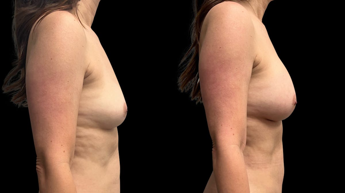 Breast Augmentation Before & After Gallery - Patient 102781 - Image 5