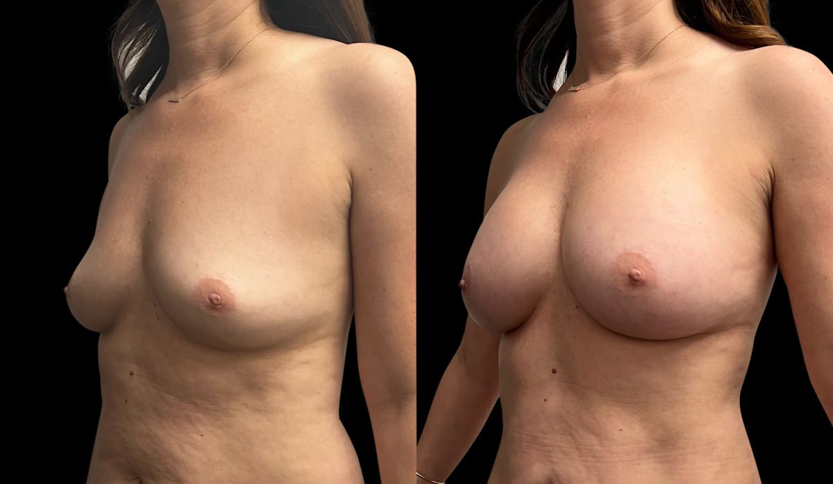 Breast Augmentation Before & After Gallery - Patient 102781 - Image 2