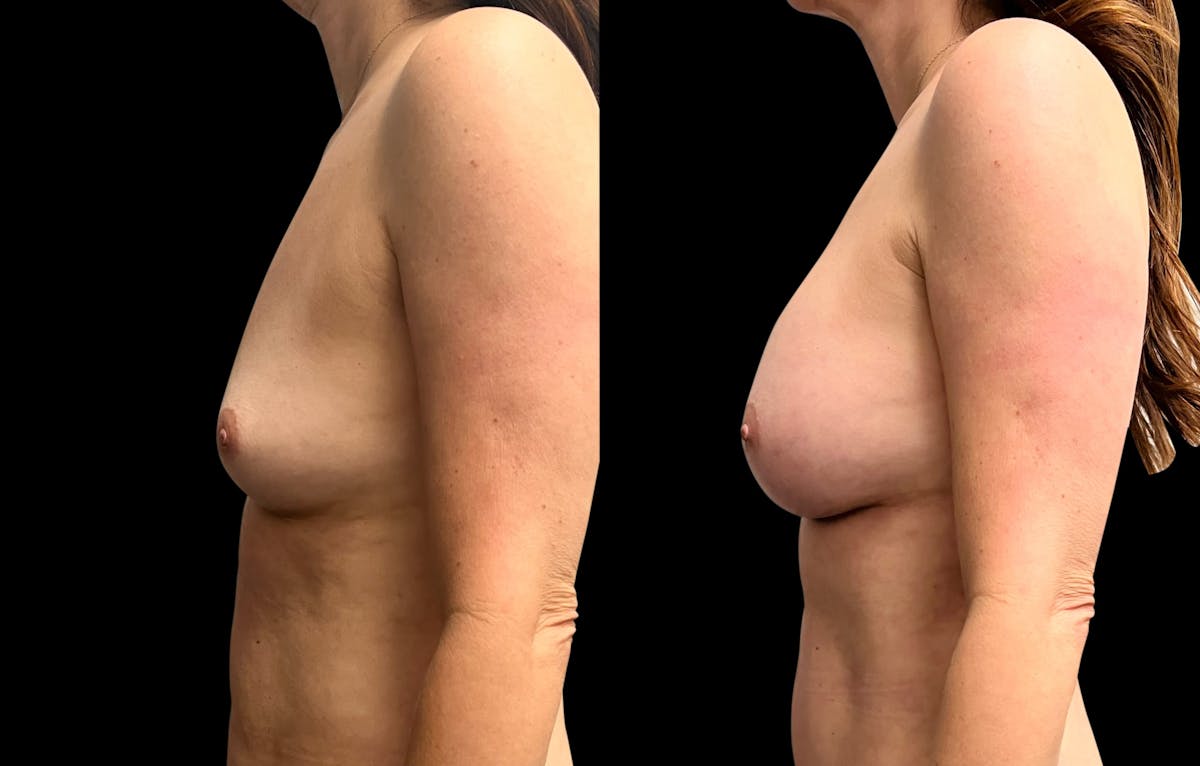 Breast Augmentation Before & After Gallery - Patient 102781 - Image 3