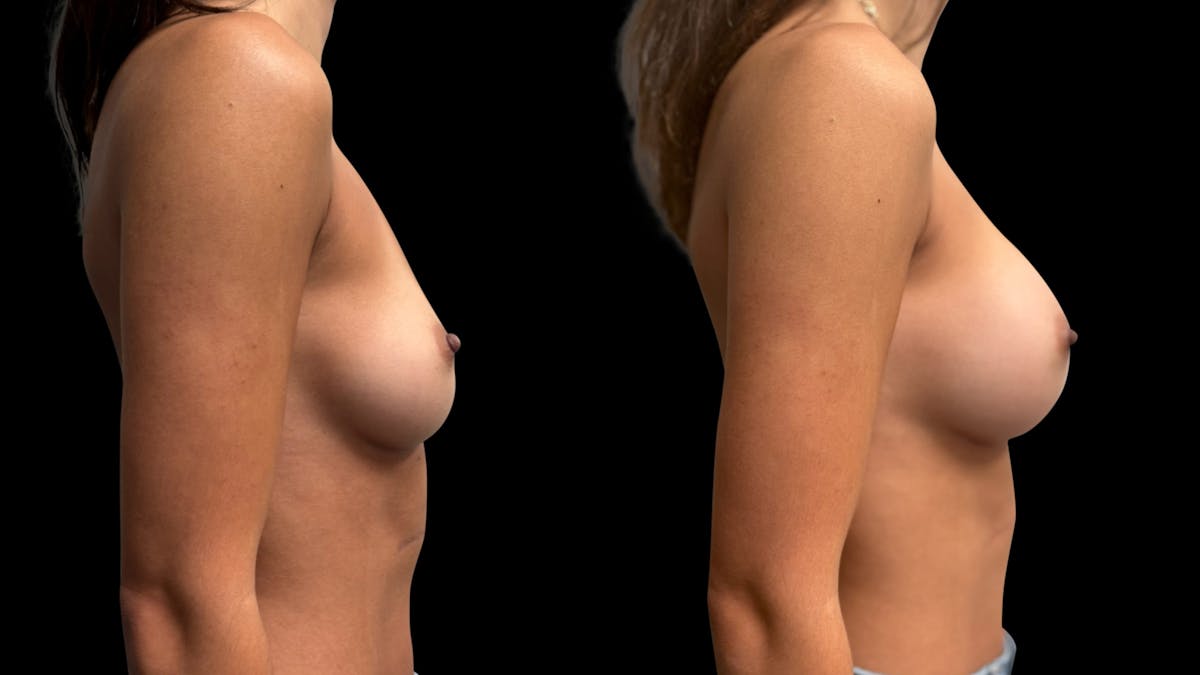 Breast Augmentation Before & After Gallery - Patient 575183 - Image 3