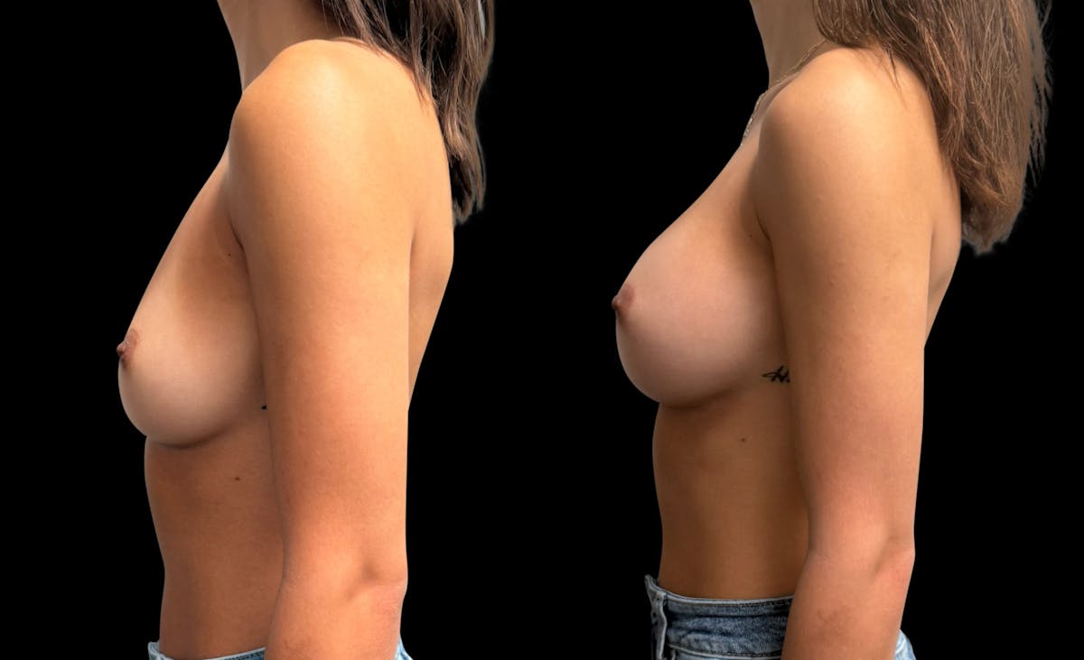 Breast Augmentation Before & After Gallery - Patient 575183 - Image 5
