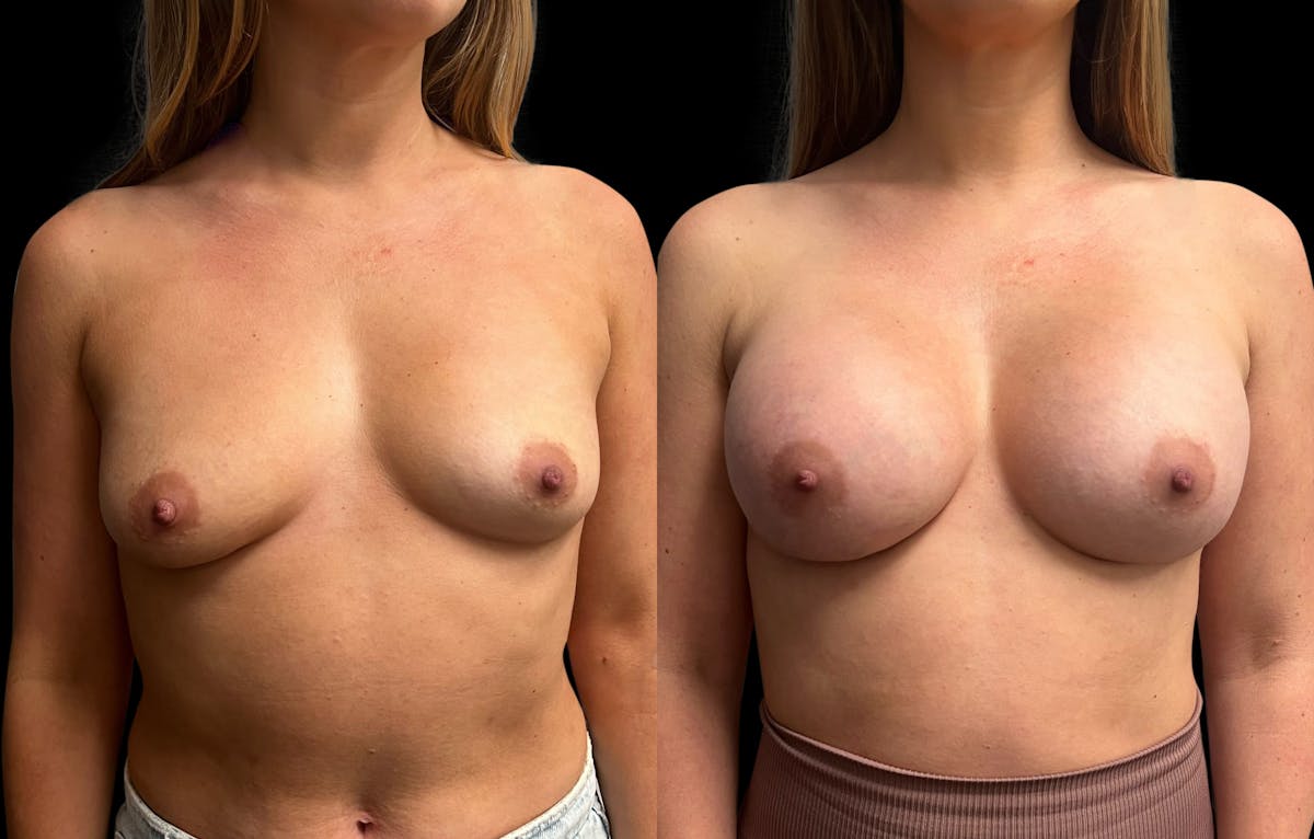 Breast Augmentation Before & After Gallery - Patient 125992 - Image 1