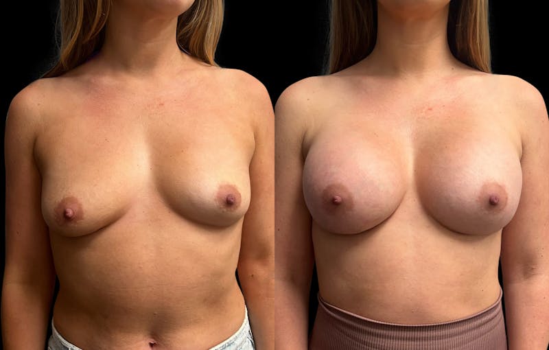 Breast Augmentation Before & After Gallery - Patient 125992 - Image 1