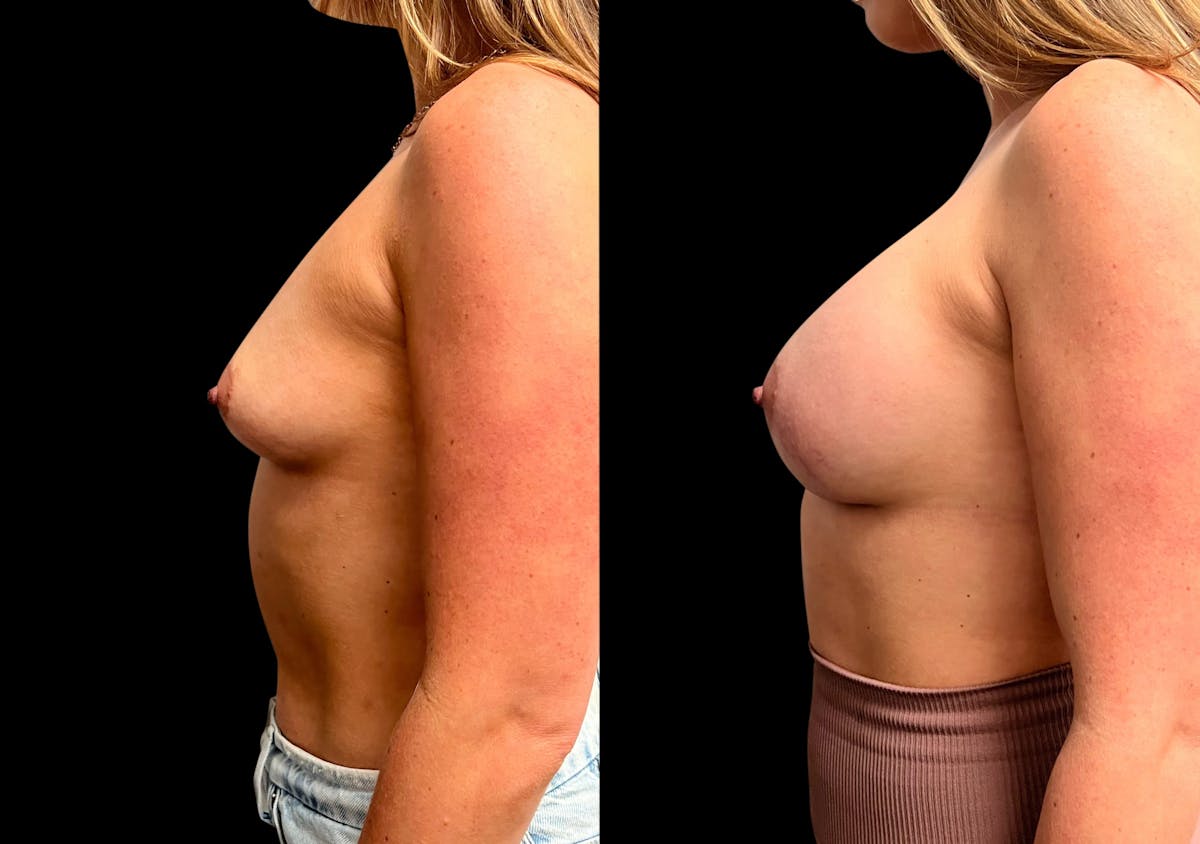 Breast Augmentation Before & After Gallery - Patient 125992 - Image 5