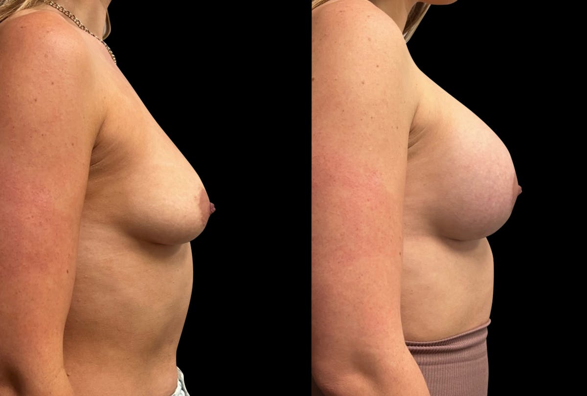 Breast Augmentation Before & After Gallery - Patient 125992 - Image 3