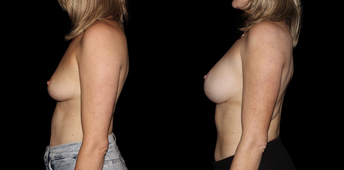 Breast Augmentation Before & After Gallery - Patient 277265 - Image 5
