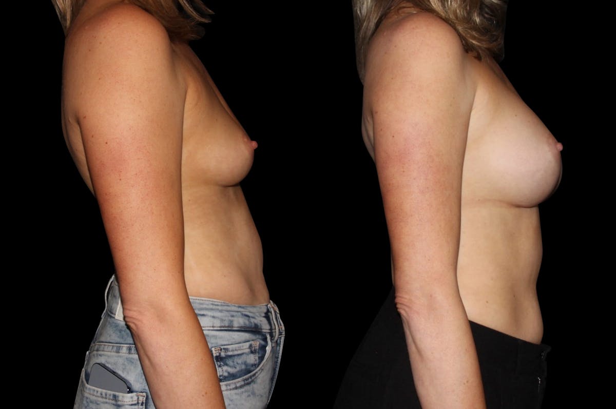Breast Augmentation Before & After Gallery - Patient 277265 - Image 3