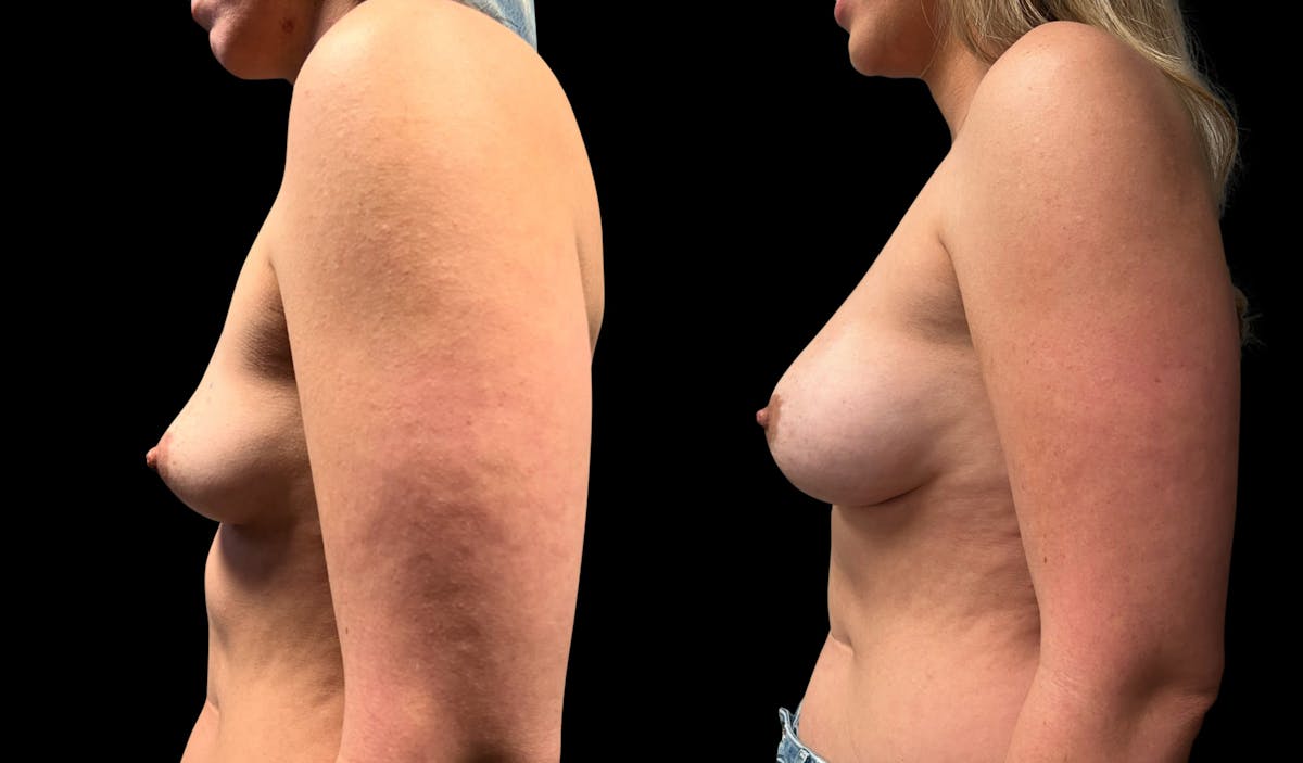 Breast Augmentation Before & After Gallery - Patient 479173 - Image 5
