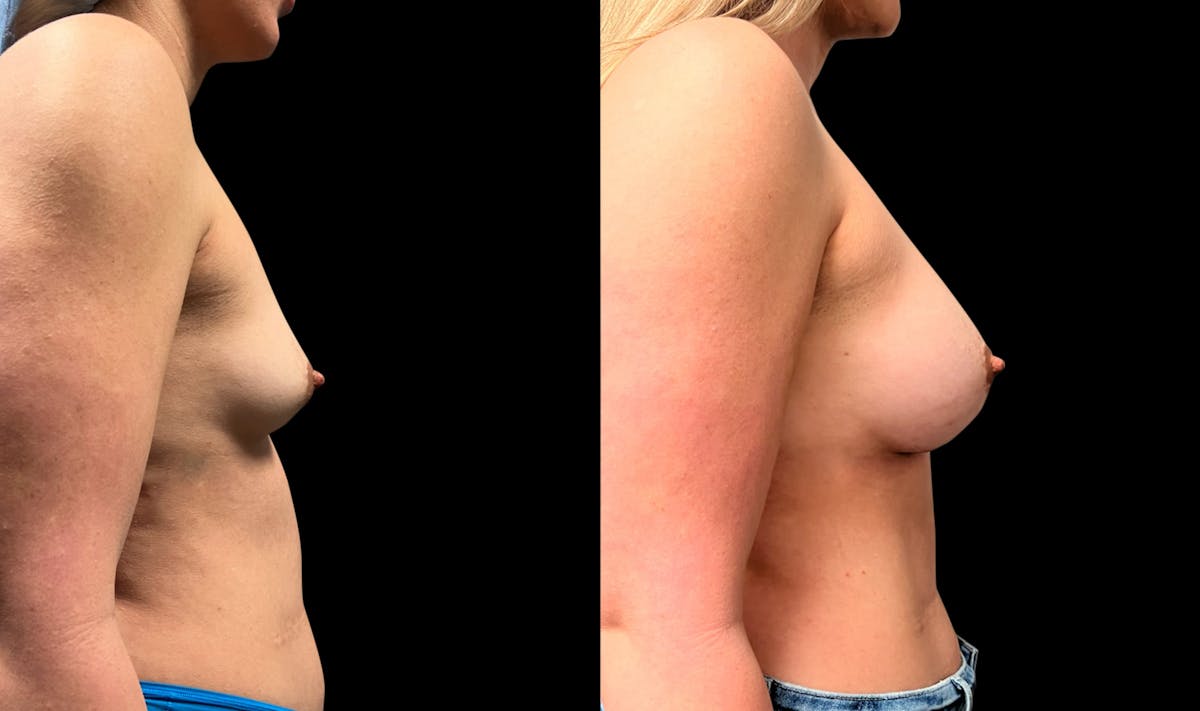 Breast Augmentation Before & After Gallery - Patient 479173 - Image 3