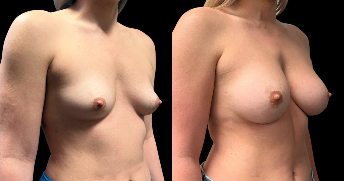 Breast Augmentation Before & After Gallery - Patient 479173 - Image 2