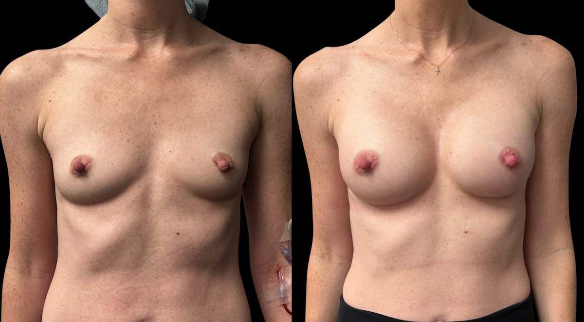 Breast Augmentation Before & After Gallery - Patient 816574 - Image 1