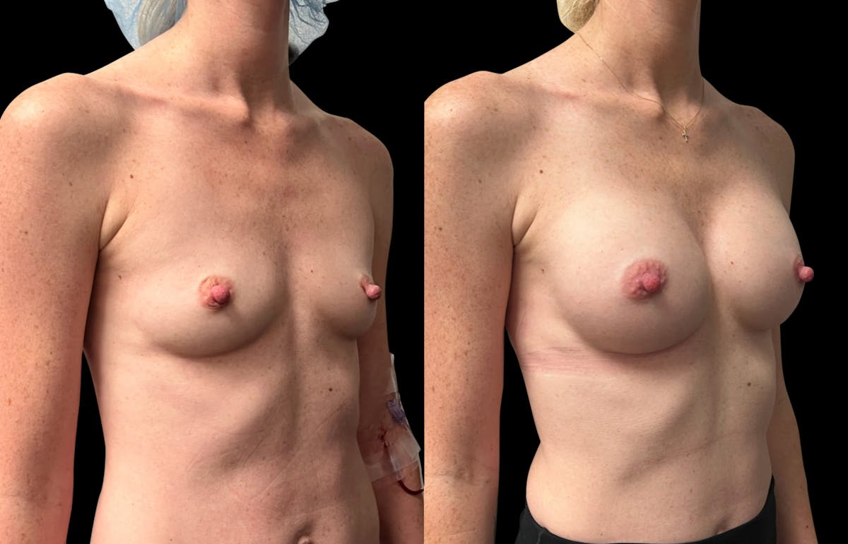 Breast Augmentation Before & After Gallery - Patient 816574 - Image 4