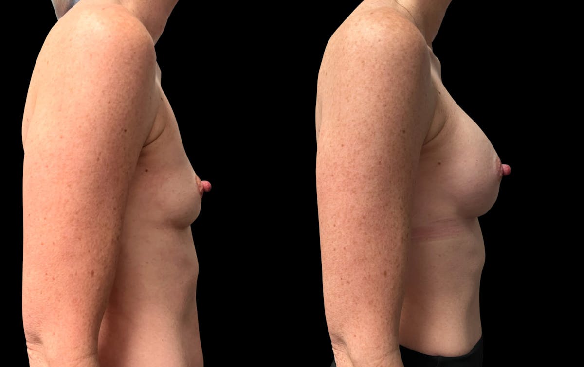 Breast Augmentation Before & After Gallery - Patient 816574 - Image 5