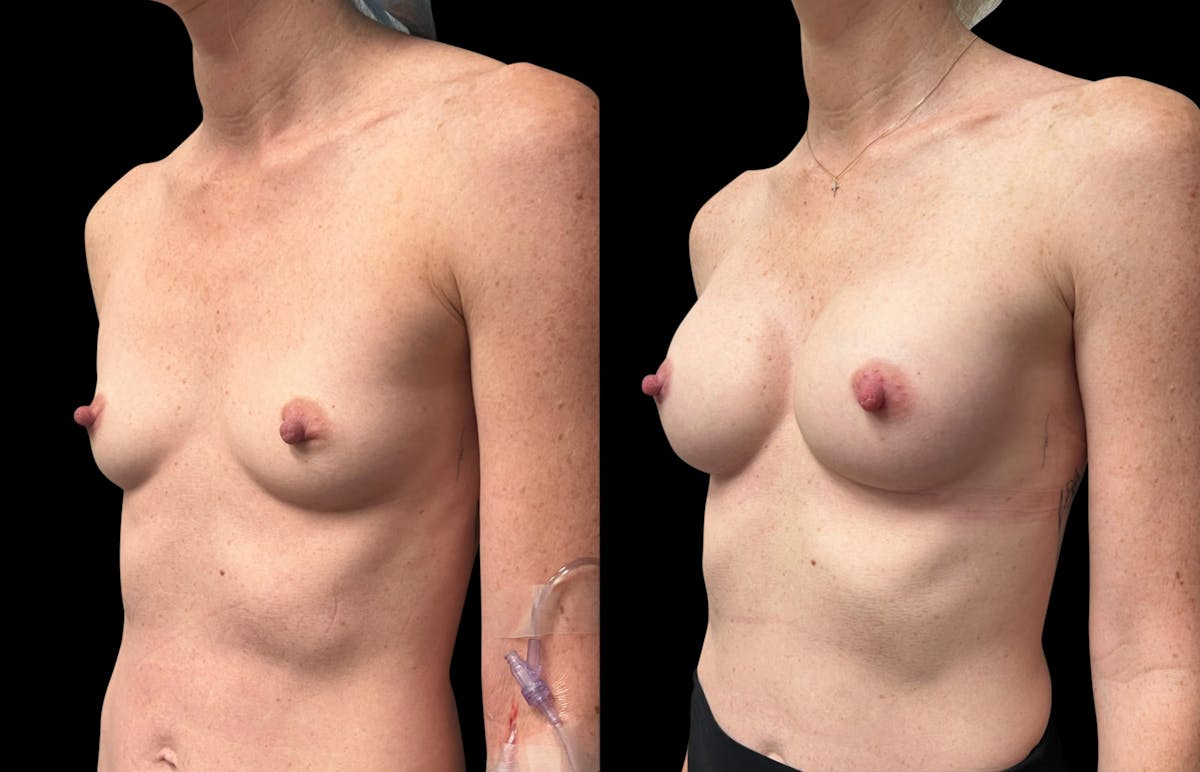 Breast Augmentation Before & After Gallery - Patient 816574 - Image 2