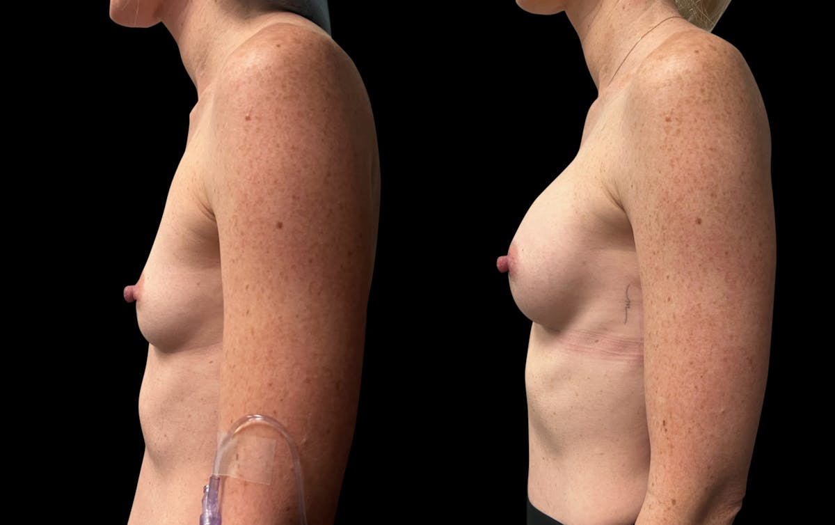 Breast Augmentation Before & After Gallery - Patient 816574 - Image 3