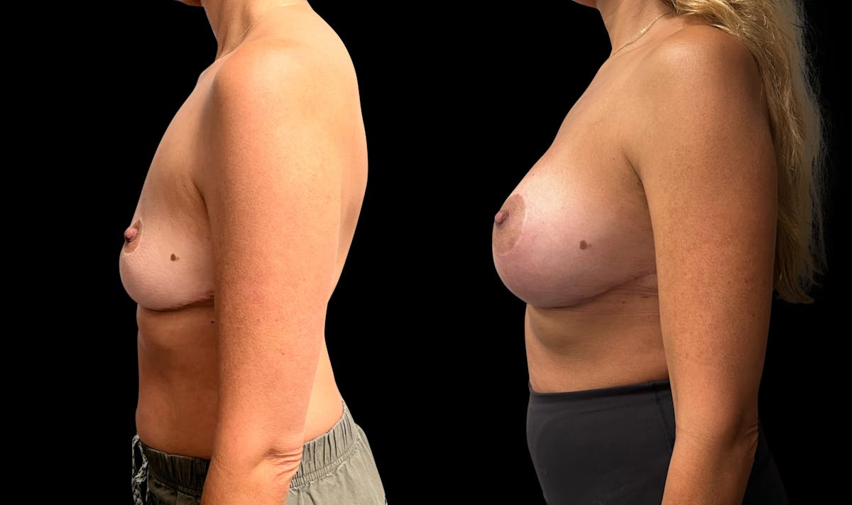 Breast Augmentation Before & After Gallery - Patient 386459 - Image 3