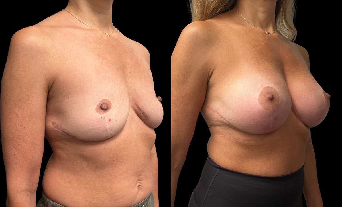 Breast Augmentation Before & After Gallery - Patient 386459 - Image 4