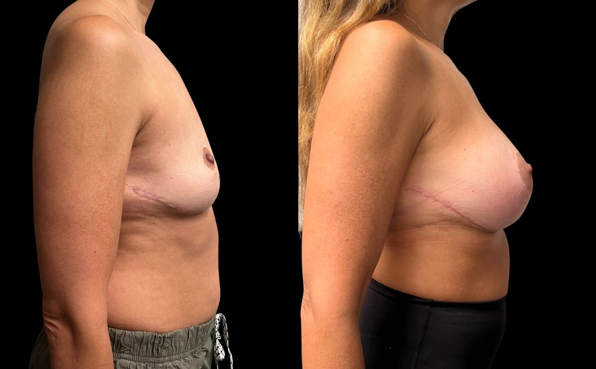 Breast Augmentation Before & After Gallery - Patient 386459 - Image 5