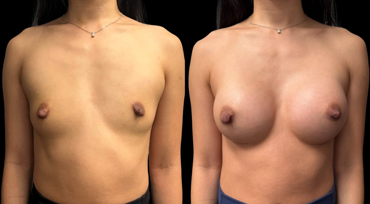 Breast Augmentation Before & After Gallery - Patient 865627 - Image 1