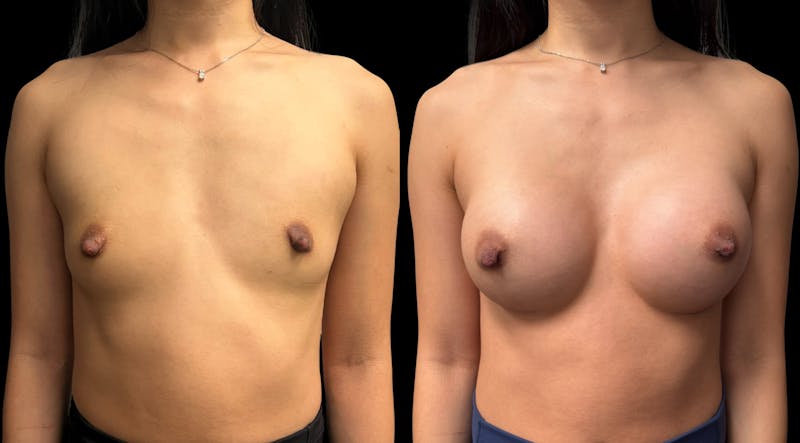 Breast Augmentation Before & After Gallery - Patient 865627 - Image 1