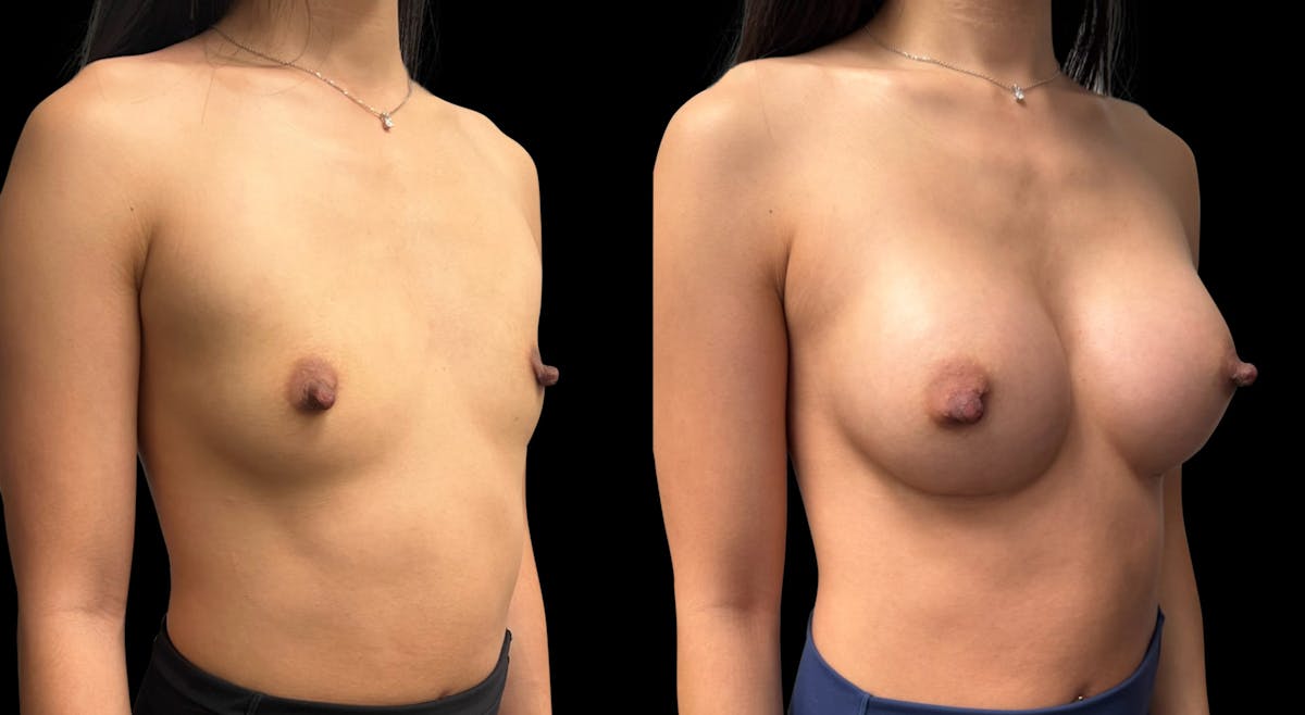 Breast Augmentation Before & After Gallery - Patient 865627 - Image 2