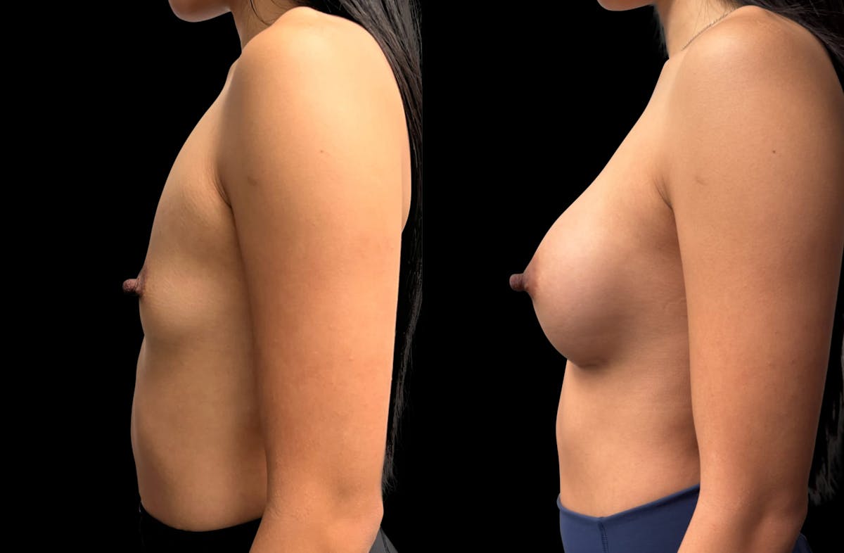 Breast Augmentation Before & After Gallery - Patient 865627 - Image 4
