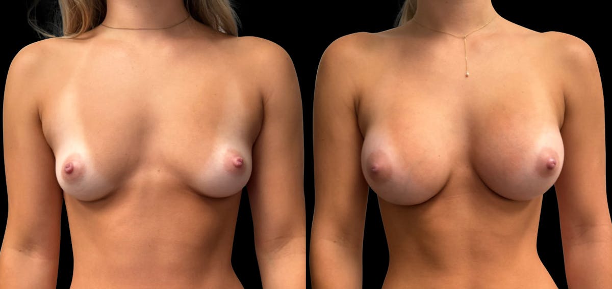 Breast Augmentation Before & After Gallery - Patient 142986 - Image 1