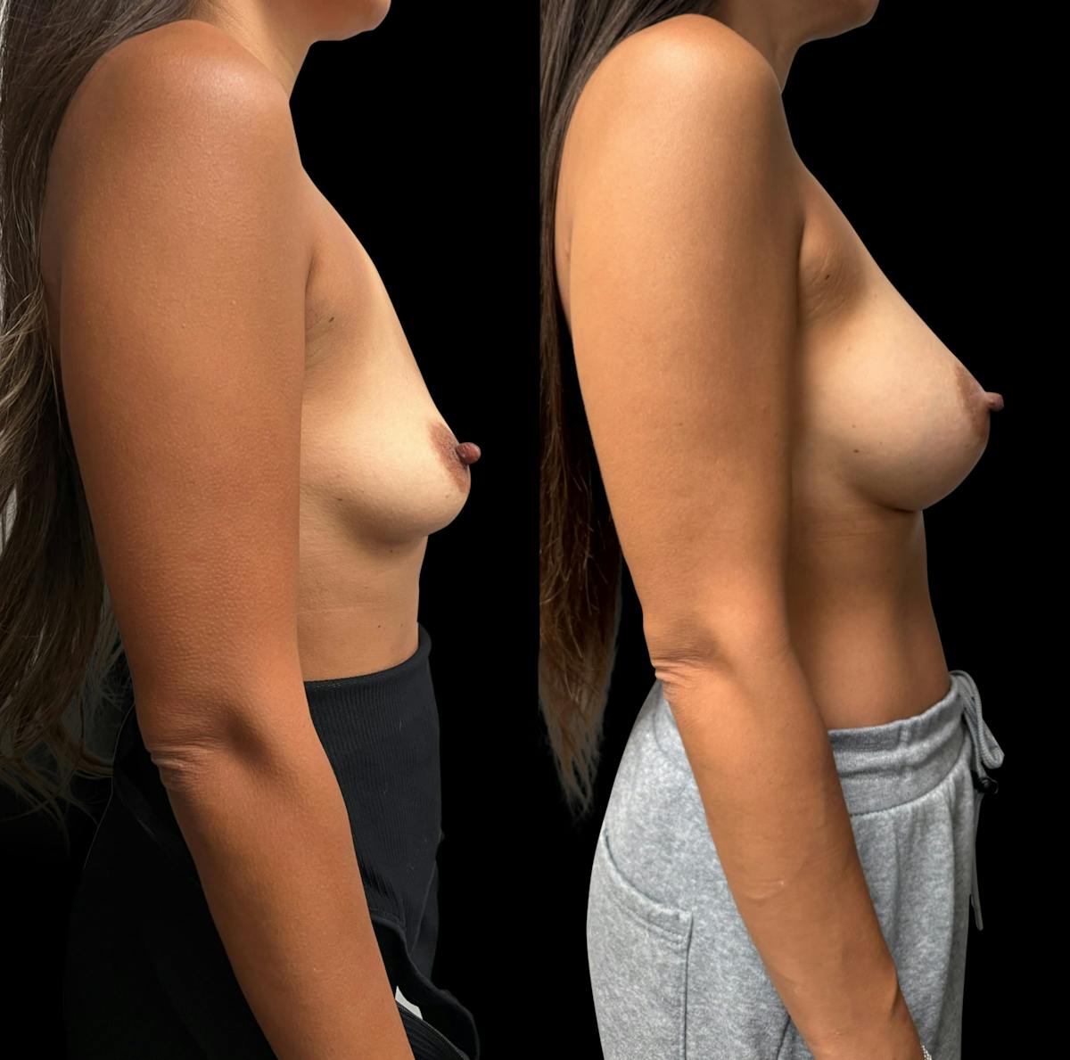Breast Augmentation Before & After Gallery - Patient 331929 - Image 3