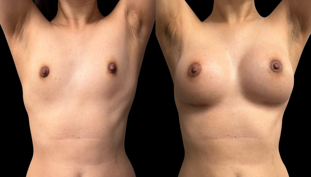 Breast Augmentation Before & After Gallery - Patient 272606 - Image 2