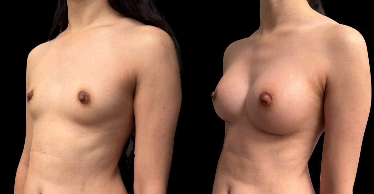 Breast Augmentation Before & After Gallery - Patient 272606 - Image 3