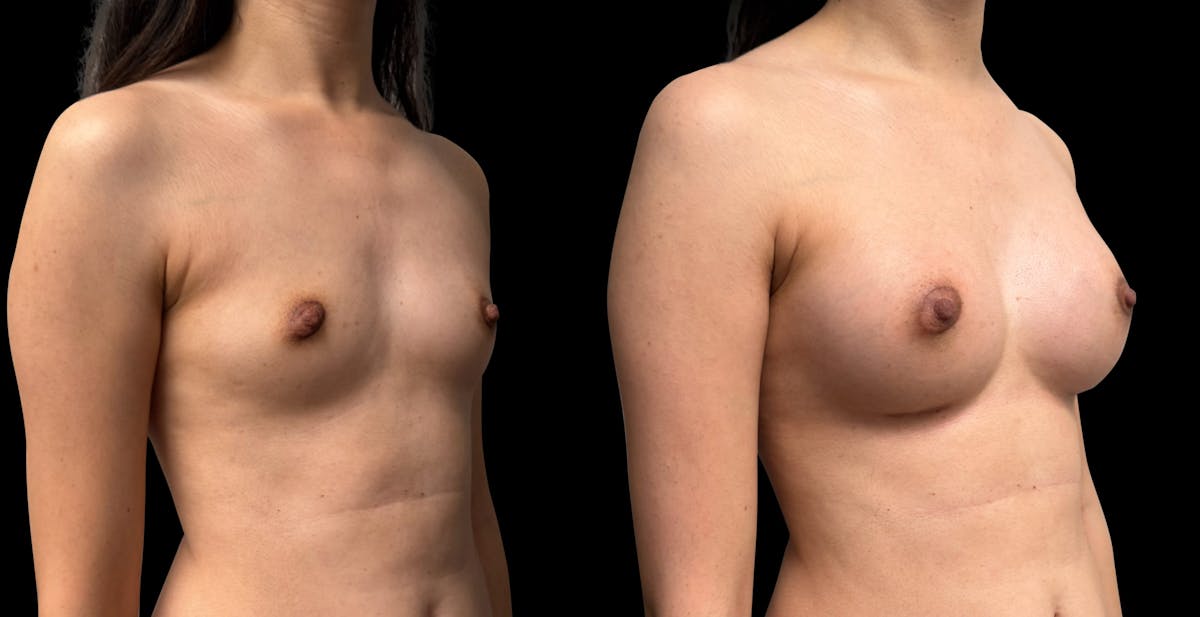 Breast Augmentation Before & After Gallery - Patient 272606 - Image 5