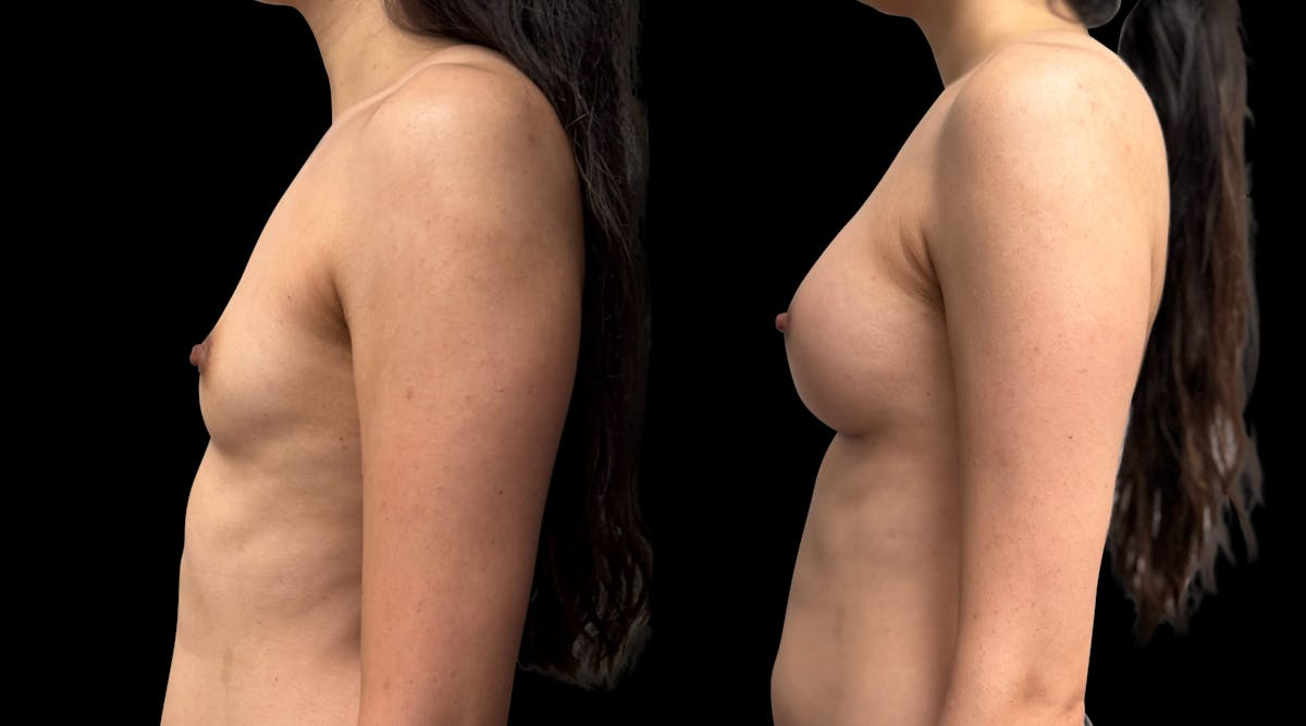Breast Augmentation Before & After Gallery - Patient 272606 - Image 4