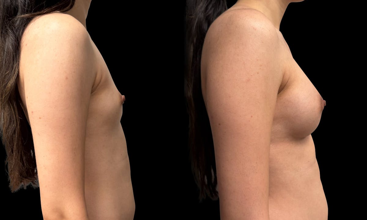 Breast Augmentation Before & After Gallery - Patient 272606 - Image 6