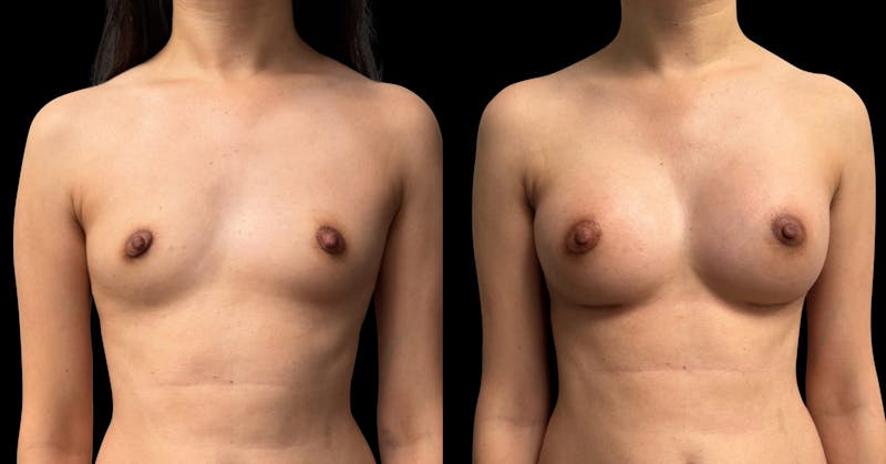 Breast Augmentation Before & After Gallery - Patient 272606 - Image 1