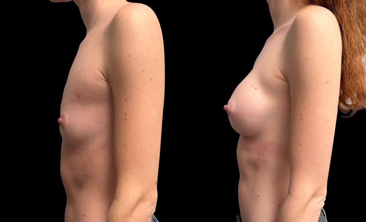 Breast Augmentation Before & After Gallery - Patient 208517 - Image 5