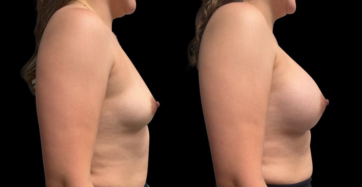 Breast Augmentation Before & After Gallery - Patient 189269 - Image 3